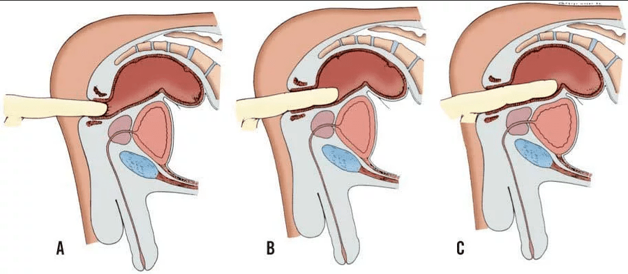 Examen rectal de los dedos